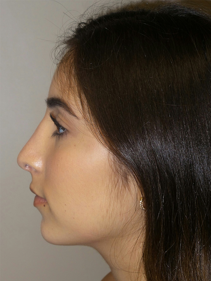 Rhinoplasty Before and After 10 | Sanjay Grover MD FACS