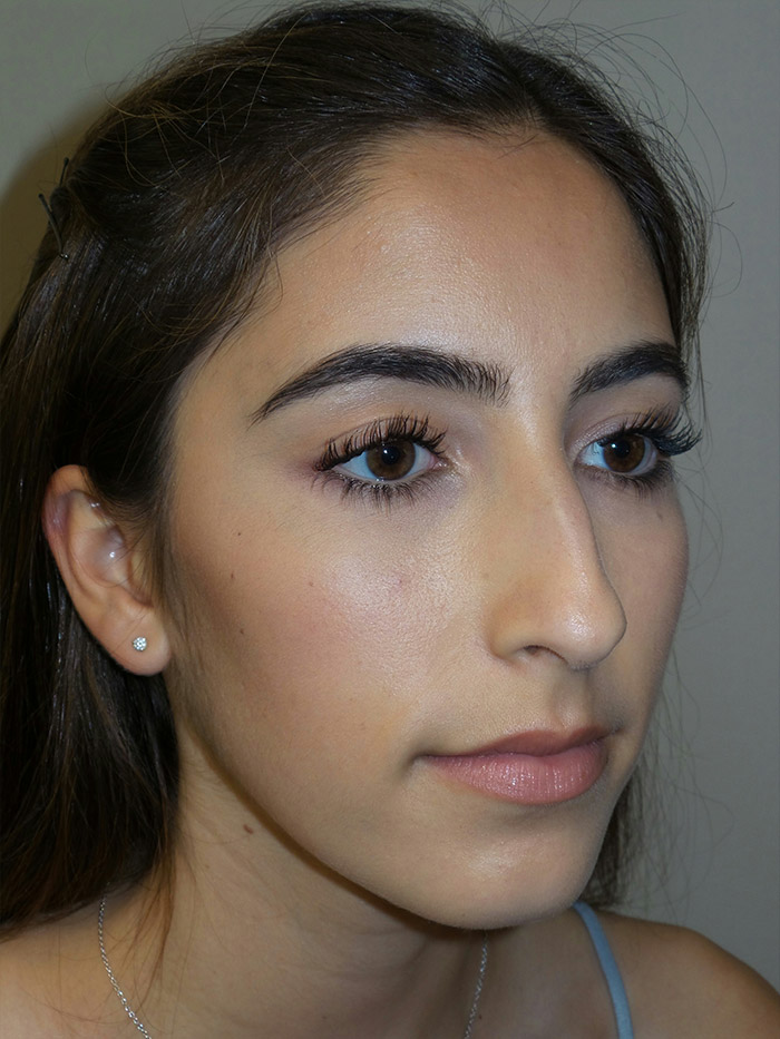 Rhinoplasty Before and After 10 | Grover Aesthetics