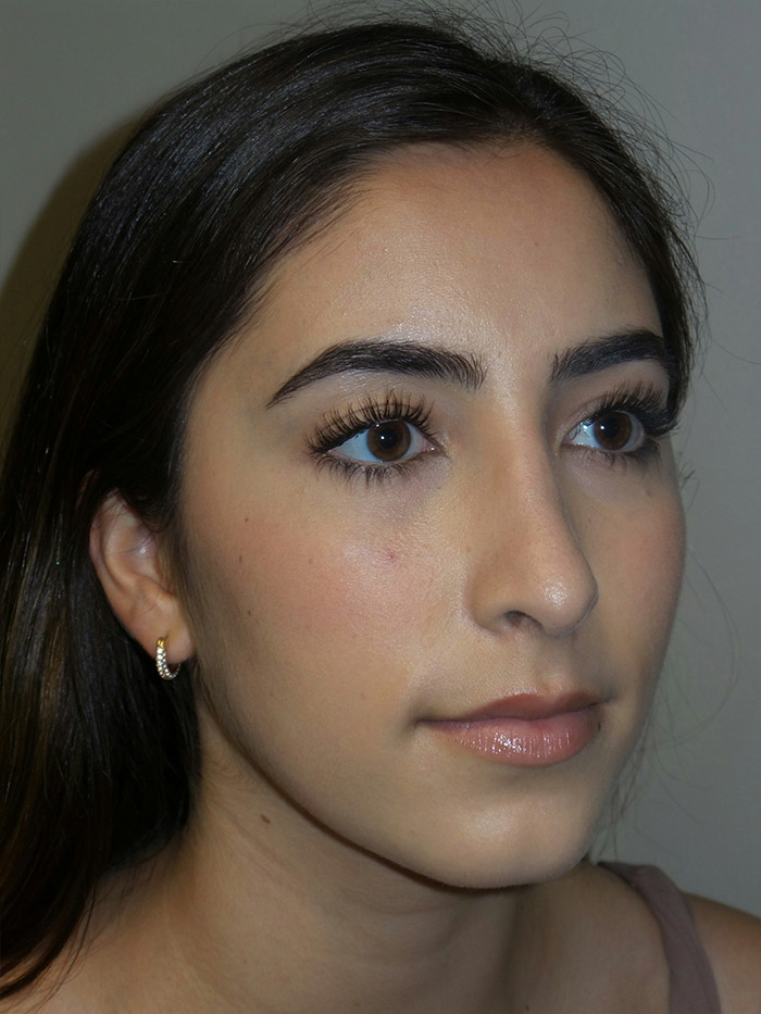 Rhinoplasty Before and After 10 | Grover Aesthetics