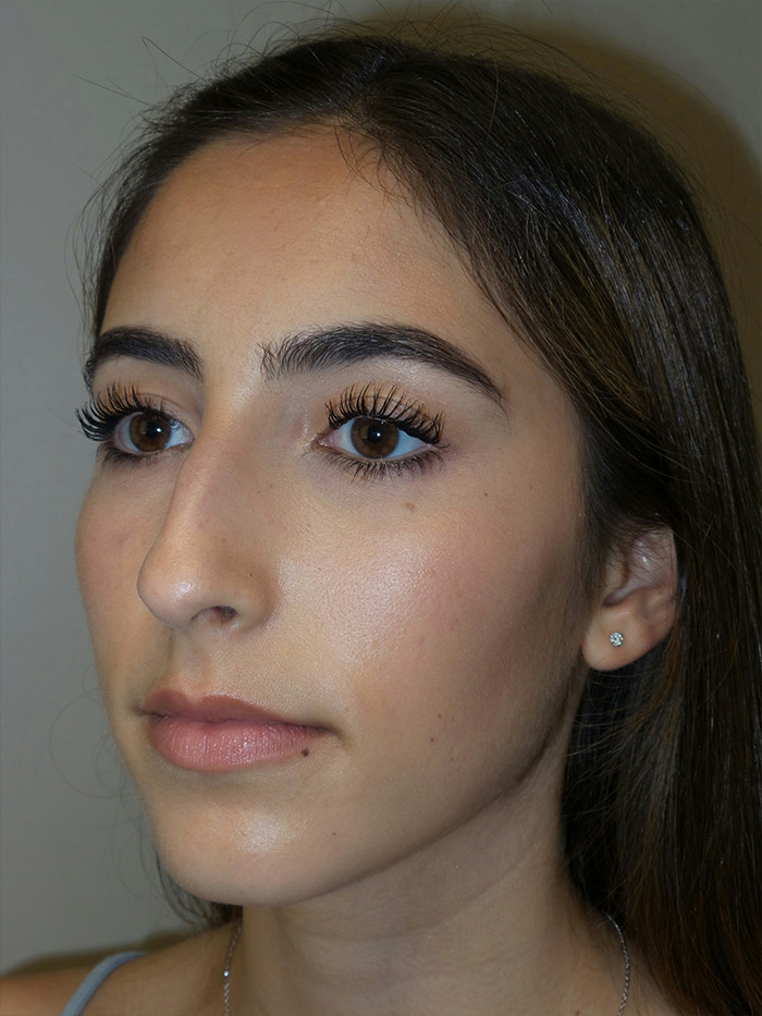 Rhinoplasty Before and After 10 | Grover Aesthetics