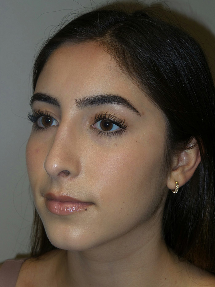 Rhinoplasty Before and After 10 | Grover Aesthetics