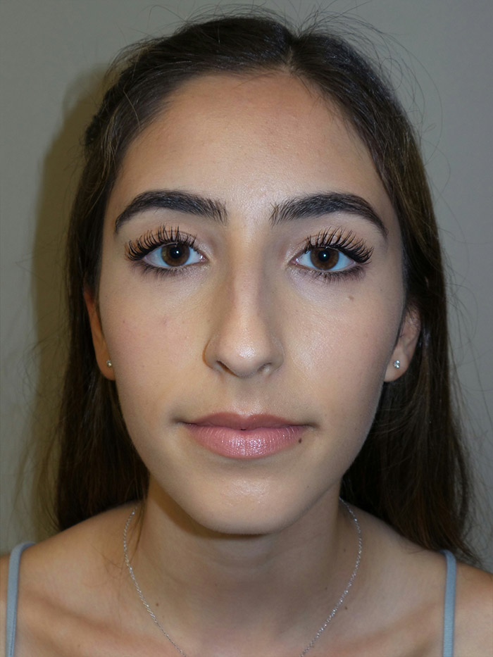 Rhinoplasty Before and After 10 | Sanjay Grover MD FACS