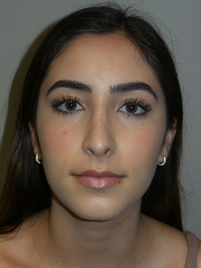 Rhinoplasty Before and After 10 | Sanjay Grover MD FACS