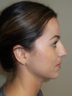 Rhinoplasty Before and After 39 | Sanjay Grover MD FACS