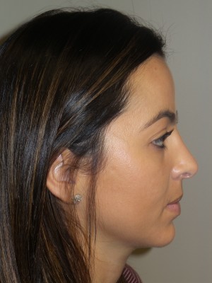 Rhinoplasty Before and After 11 | Sanjay Grover MD FACS