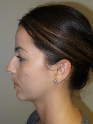 Rhinoplasty Before and After 11 | Grover Aesthetics