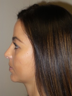 Rhinoplasty Before and After 11 | Sanjay Grover MD FACS