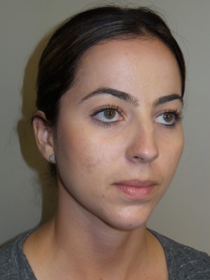 Rhinoplasty Before and After 11 | Grover Aesthetics