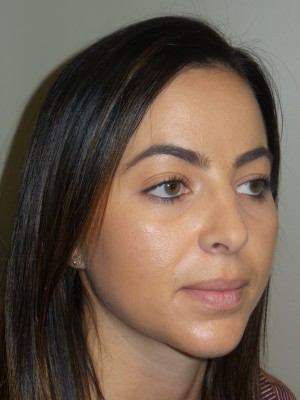 Rhinoplasty Before and After 11 | Grover Aesthetics