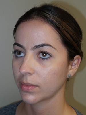 Rhinoplasty Before and After 11 | Sanjay Grover MD FACS