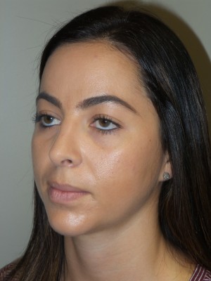 Rhinoplasty Before and After 11 | Sanjay Grover MD FACS