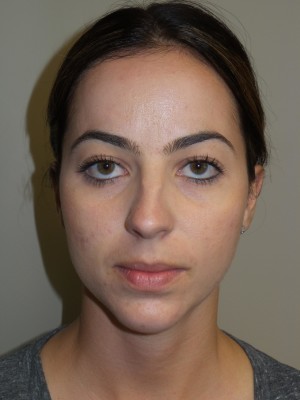 Rhinoplasty Before and After 11 | Grover Aesthetics