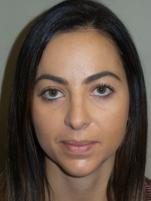 Rhinoplasty Before and After 11 | Grover Aesthetics