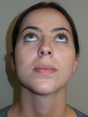 Rhinoplasty Before and After 11 | Grover Aesthetics