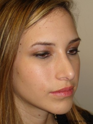 Rhinoplasty Before and After 12 | Grover Aesthetics