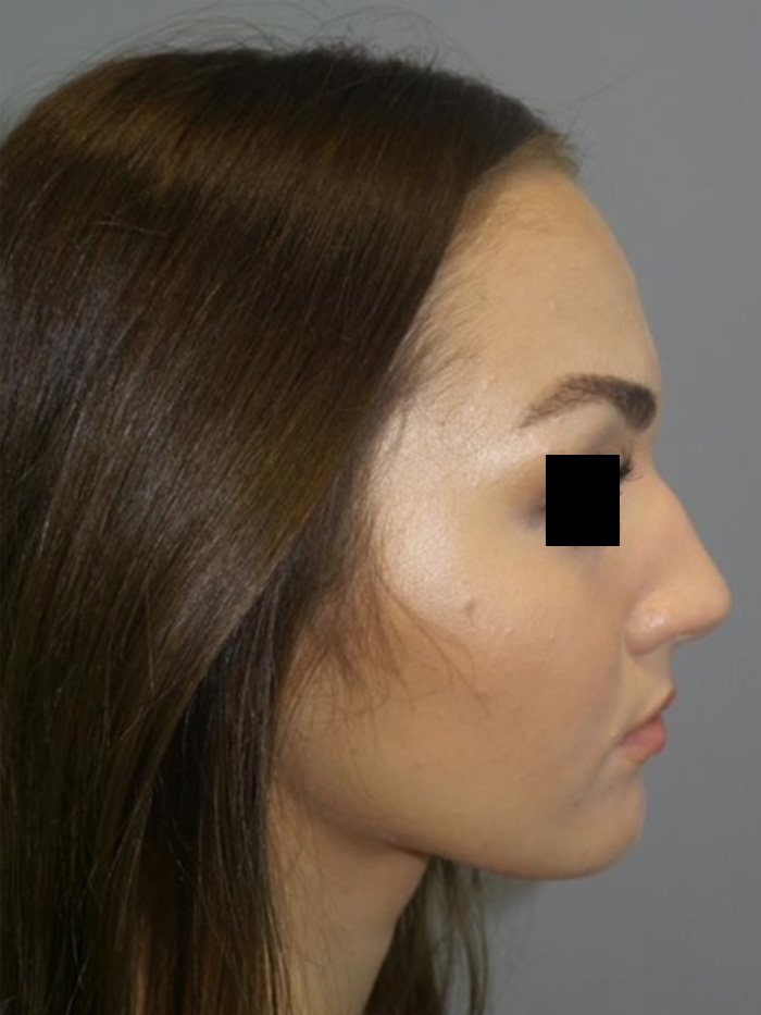 Rhinoplasty Before and After | Grover Aesthetics