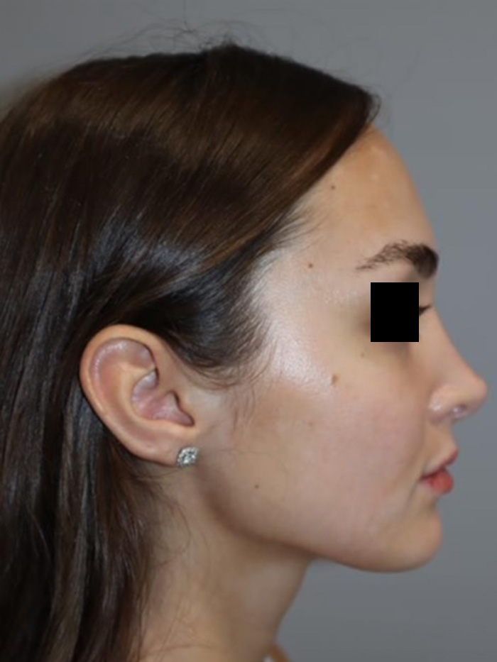 Rhinoplasty Before and After | Grover Aesthetics