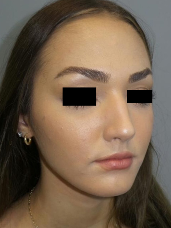 Rhinoplasty Before and After 13 | Grover Aesthetics