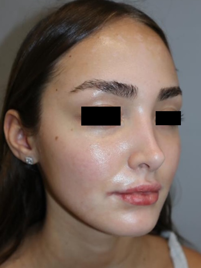 Rhinoplasty Before and After 13 | Grover Aesthetics