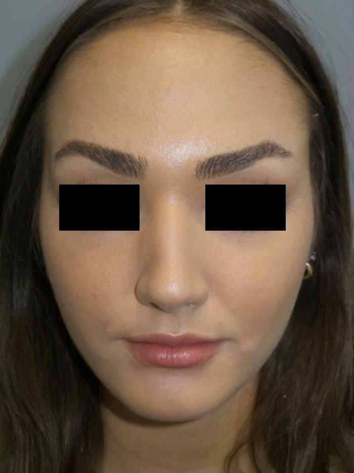 Rhinoplasty Before and After 13 | Grover Aesthetics