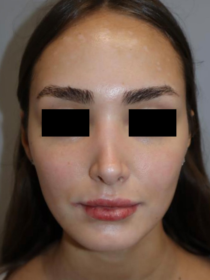 Rhinoplasty Before and After 13 | Grover Aesthetics