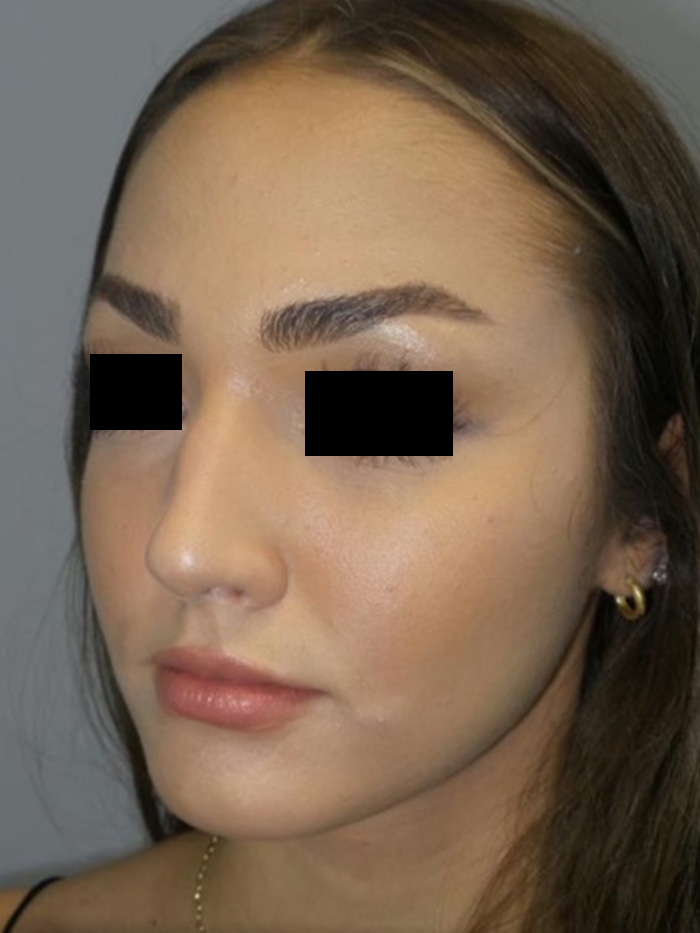 Rhinoplasty Before and After 13 | Grover Aesthetics