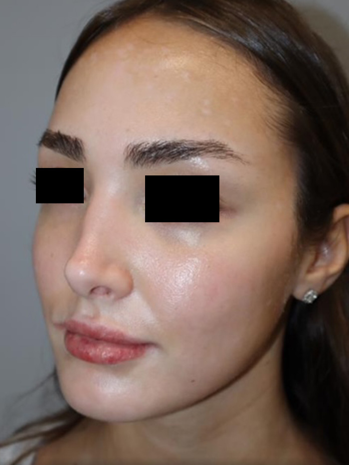 Rhinoplasty Before and After 13 | Grover Aesthetics