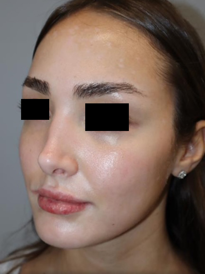 Rhinoplasty Before and After 13 | Sanjay Grover MD FACS