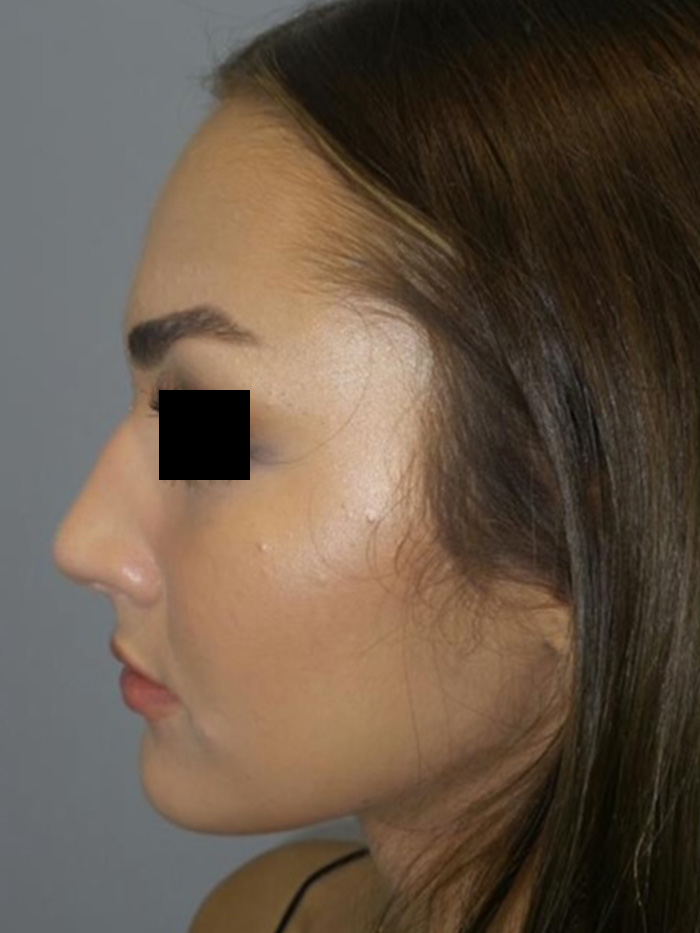 Rhinoplasty Before and After 13 | Grover Aesthetics