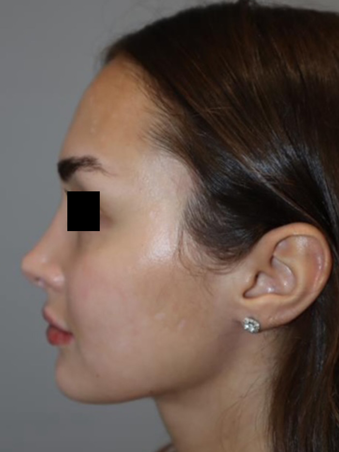Rhinoplasty Before and After 13 | Grover Aesthetics