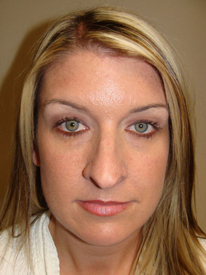 Rhinoplasty Before and After | Grover Aesthetics