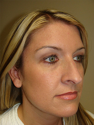 Rhinoplasty Before and After 14 | Grover Aesthetics