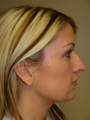 Rhinoplasty Before and After 14 | Sanjay Grover MD FACS