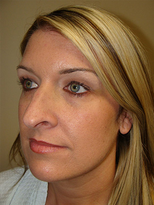 Rhinoplasty Before and After 14 | Grover Aesthetics