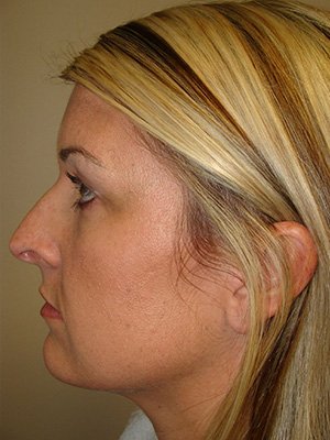 Rhinoplasty Before and After 14 | Sanjay Grover MD FACS