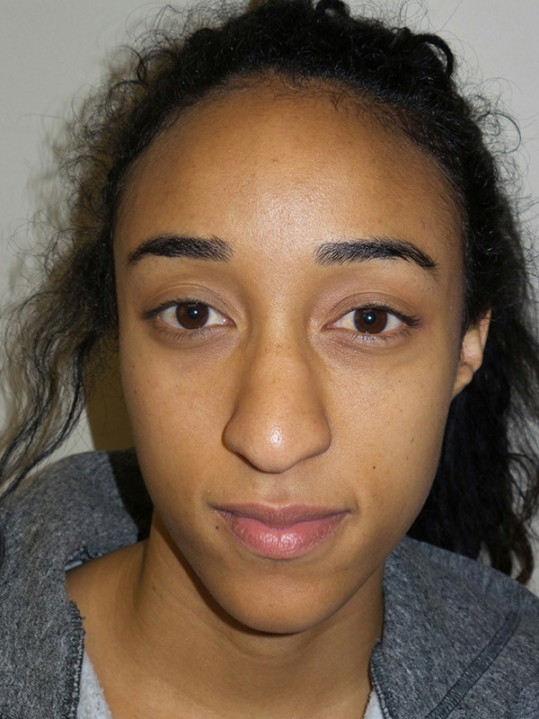 Rhinoplasty Before and After | Grover Aesthetics