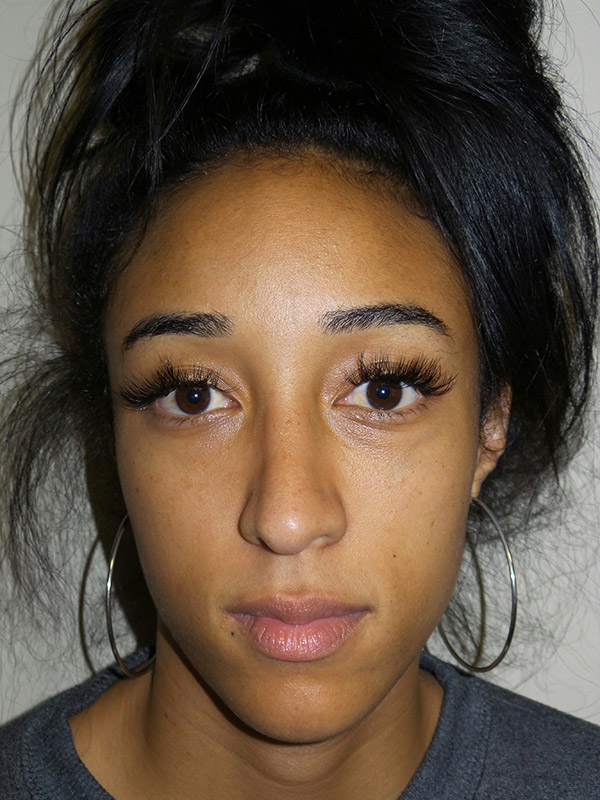 Rhinoplasty Before and After | Grover Aesthetics