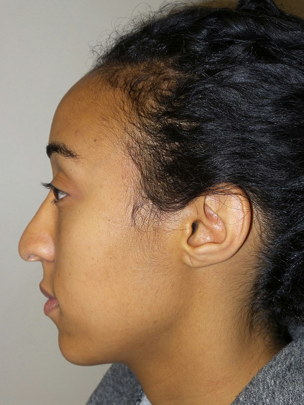 Rhinoplasty Before and After 15 | Sanjay Grover MD FACS