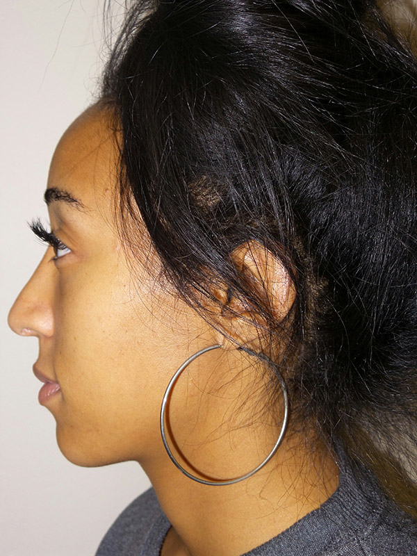 Rhinoplasty Before and After 15 | Sanjay Grover MD FACS