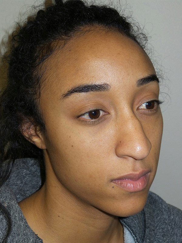Rhinoplasty Before and After 15 | Grover Aesthetics