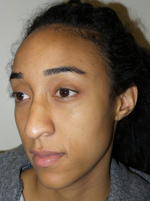 Rhinoplasty Before and After 15 | Grover Aesthetics