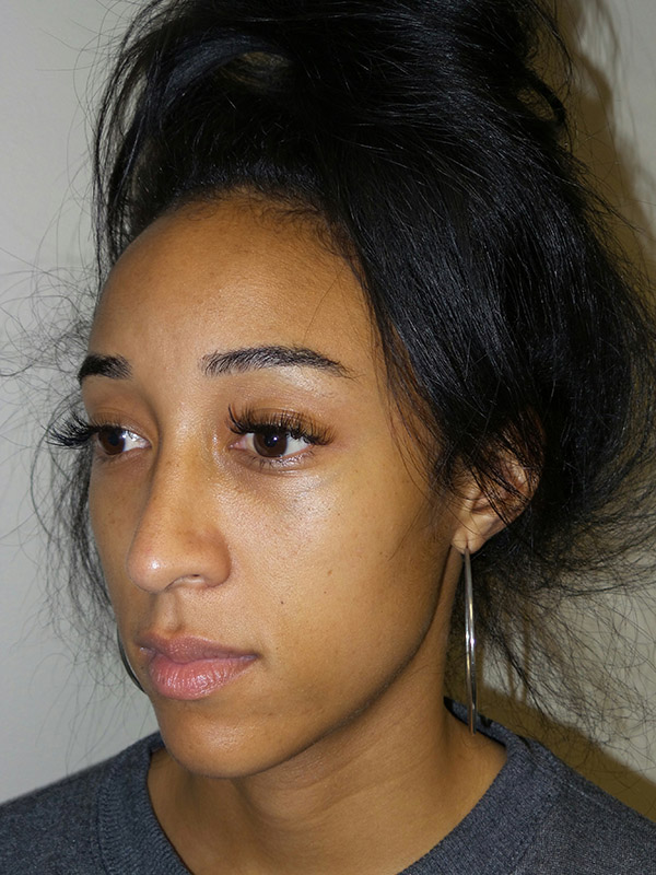 Rhinoplasty Before and After 15 | Grover Aesthetics