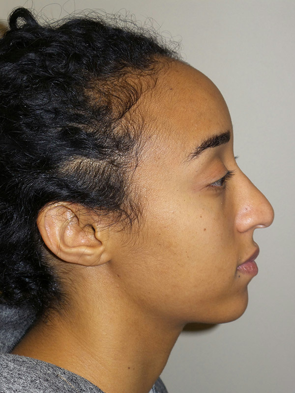 Rhinoplasty Before and After 15 | Sanjay Grover MD FACS