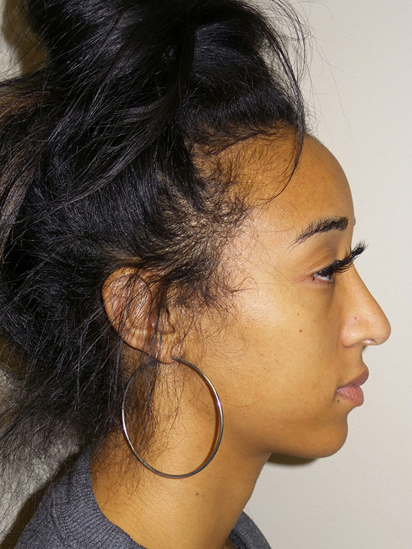 Rhinoplasty Before and After 15 | Grover Aesthetics