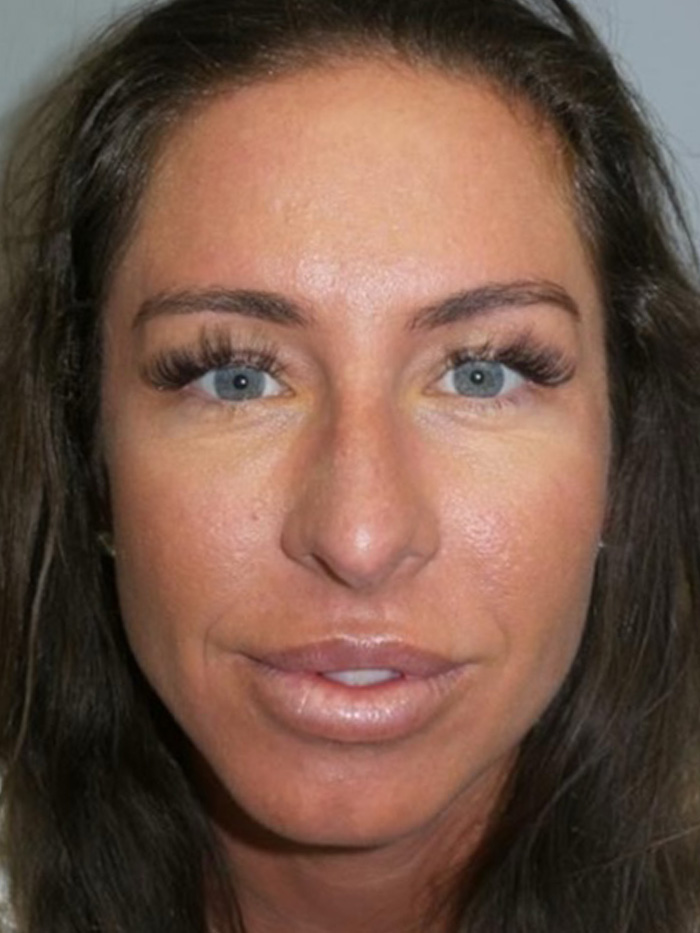 Rhinoplasty Before and After 16 | Grover Aesthetics