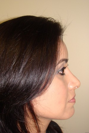 Rhinoplasty Before and After | Grover Aesthetics