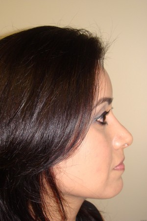 Rhinoplasty Before and After | Sanjay Grover MD FACS