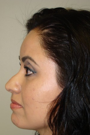 Rhinoplasty Before and After 17 | Sanjay Grover MD FACS