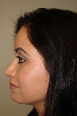 Rhinoplasty Before and After 17 | Grover Aesthetics