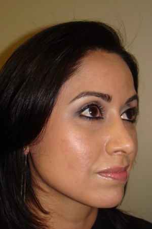 Rhinoplasty Before and After 17 | Grover Aesthetics